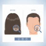 탈모 초기 증상 자가진단 가이드 썸네일