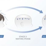 모발이식 암흑기 타임라인과 회복 과정 안내 썸네일