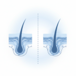모발이식 모낭염 원인과 관리법 썸네일