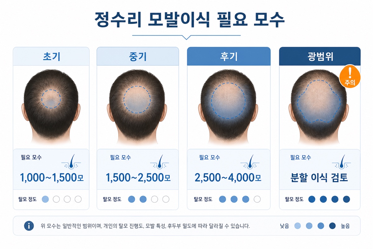 정수리 모발이식 필요 모수와 탈모 진행 단계별 비교표