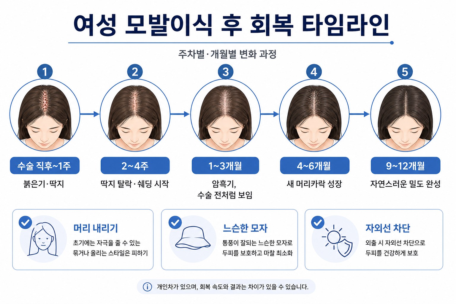 여성 모발이식 후 회복 타임라인 주차별 변화
