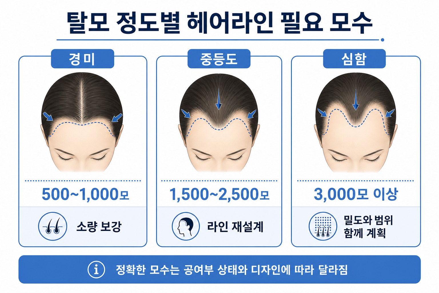 헤어라인 모발이식 상태별 필요 모수 비교 인포그래픽