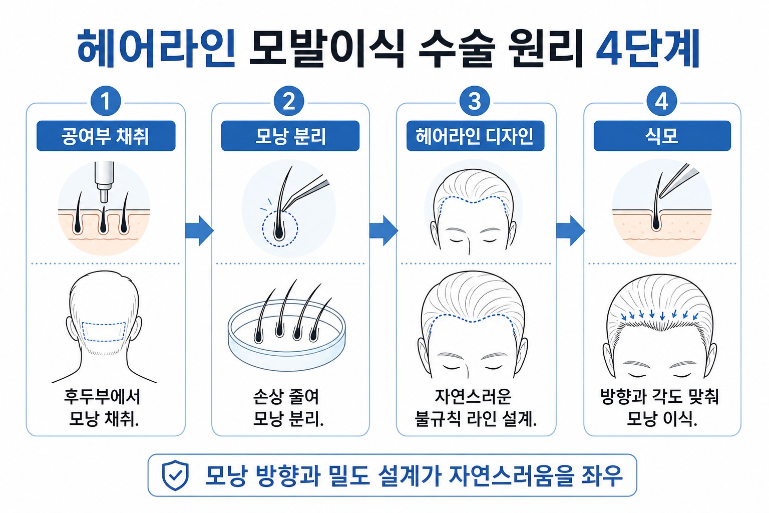 헤어라인 모발이식 수술 원리와 이식 위치 설명 인포그래픽