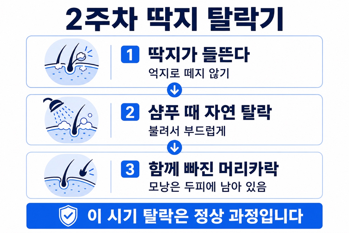 모발이식 2주차 딱지 탈락 과정 인포그래픽