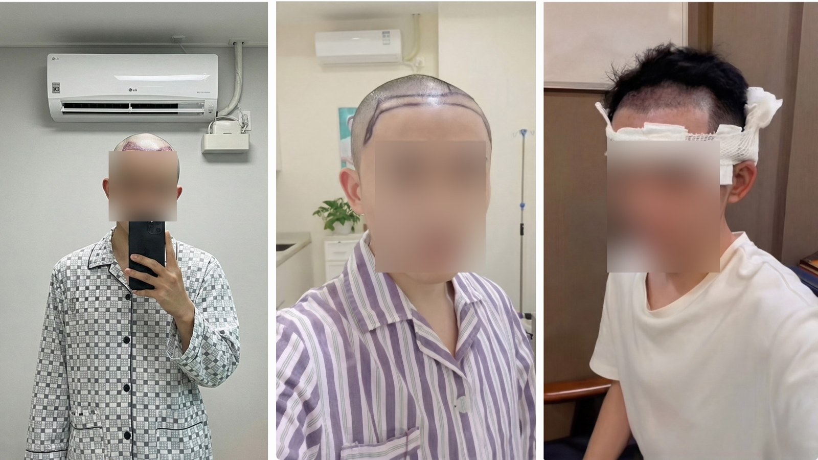 모발이식 수술 직후 삭발 상태와 헤어라인 마킹