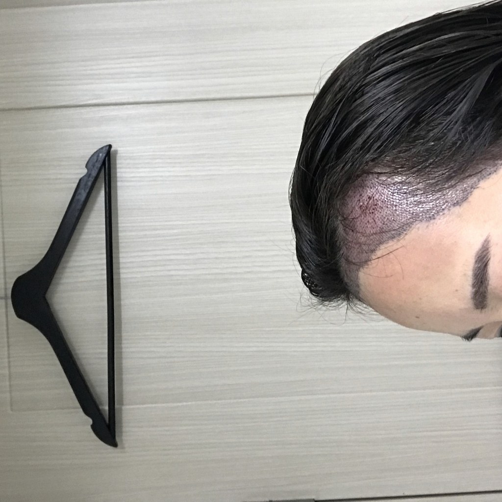 모발이식 직후 이식 부위의 자주빛 딱지 라인