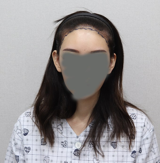 모발이식 구매 시점 정면 이마 라인