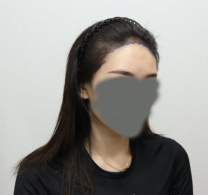 같은 사용자의 한 달 뒤 정면 이마 라인